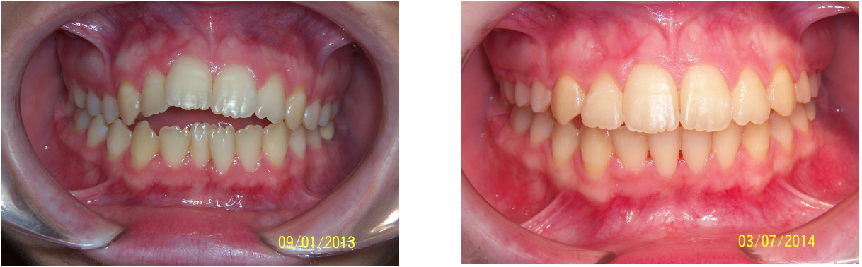 an image showing a set of teeth before and after the dental treatment